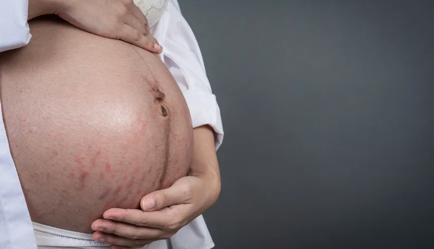 Naturalne sposoby walki z trądzikiem w ciąży